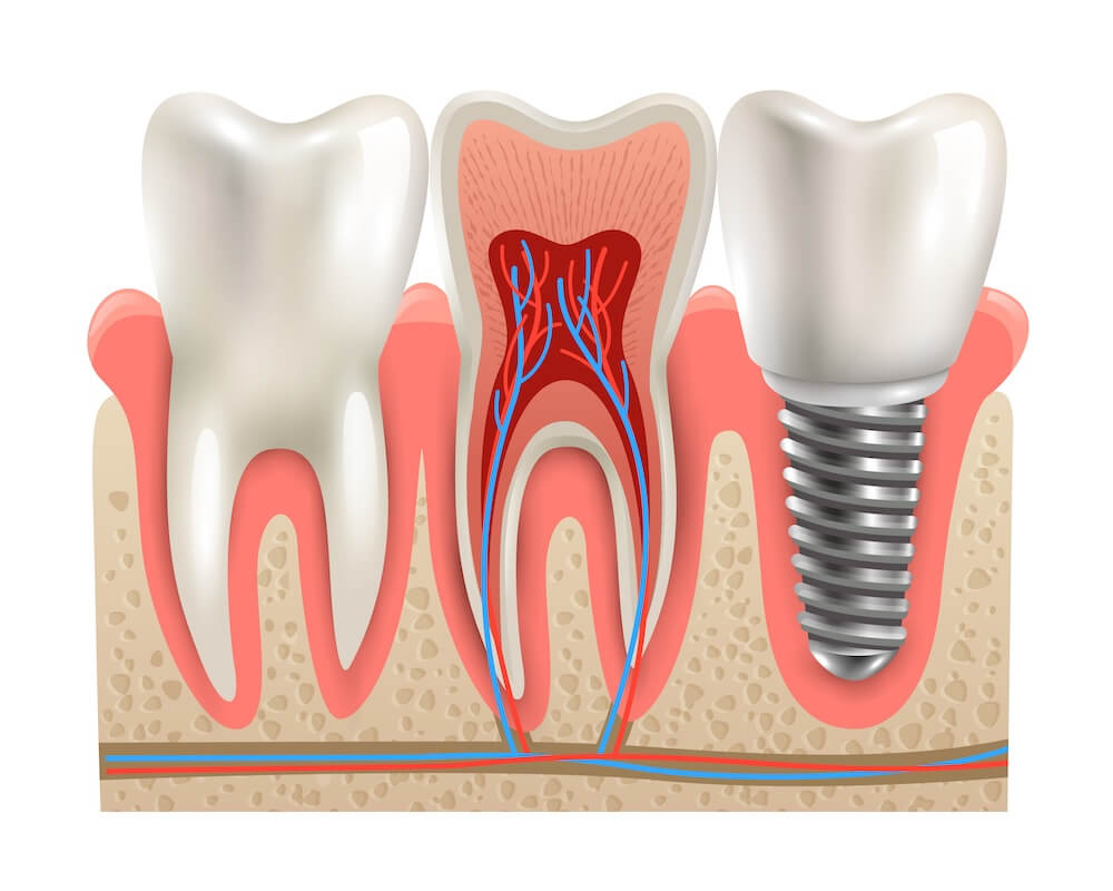 what is dental implants